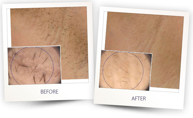 arion-hair-removal-2