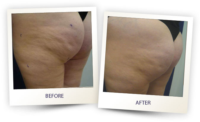 alma-cellulite-before-after-1