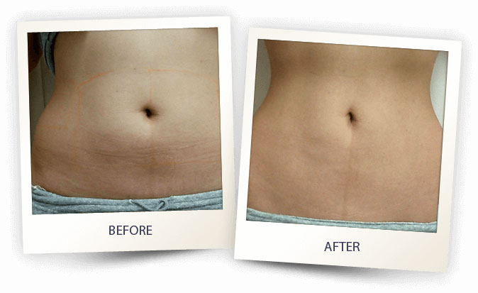 alma-cellulite-before-after-2