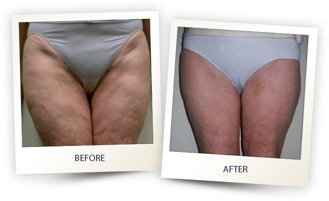 alma-cellulite-before-after-3