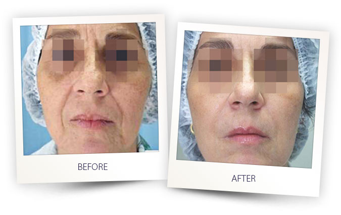 alma-remodeling-skin-before-after-5