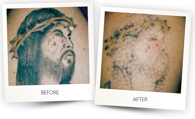 alma-before-after-tatoo-03