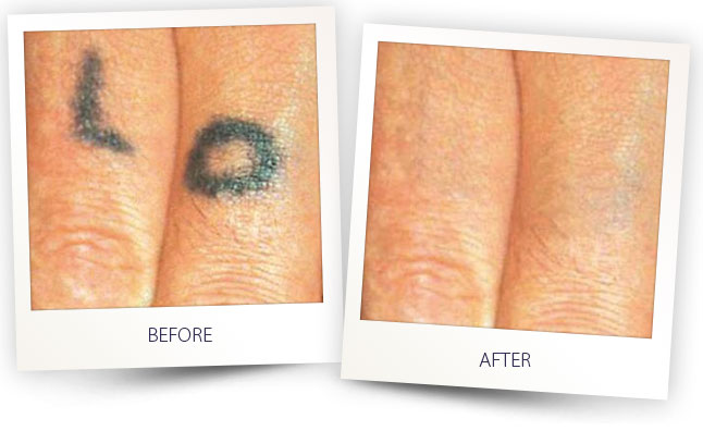 alma-before-after-tatoo-04
