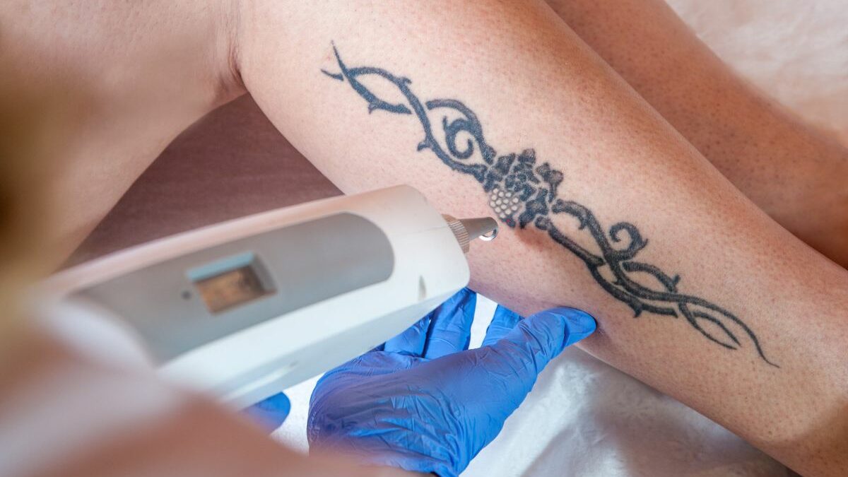 Лазерно премахване на татуировки